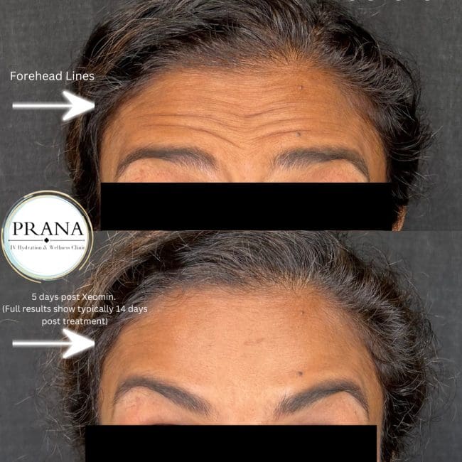 Xeomin Before and After - Case 3, Image 1 - Male, age 25 – 34 - Fortville, IN - PRANA IV Hydration & Wellness Clinic