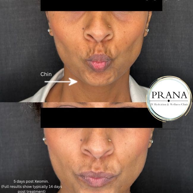 Xeomin Before and After - Case 4, Image 1 - Male, age 25 – 34 - Fortville, IN - PRANA IV Hydration & Wellness Clinic