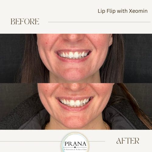 Xeomin Before and After - Case 5, Image 1 - Male, age 25 – 34 - Fortville, IN - PRANA IV Hydration & Wellness Clinic