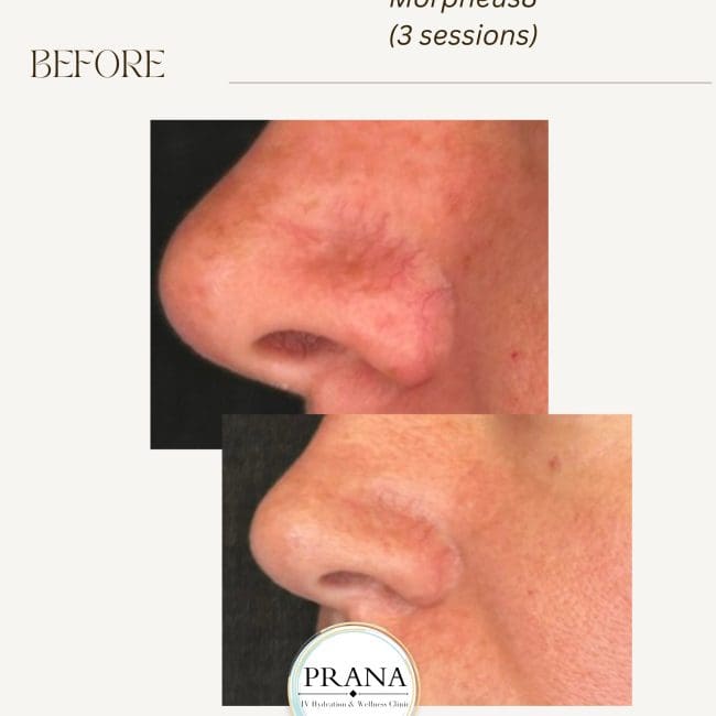 Morpheus8 Before and After - Case 2, Image 1 - Female, age 25 – 34 - Fortville, IN - PRANA IV Hydration & Wellness Clinic