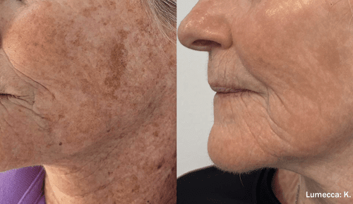Lumecca IPL Before and After - Case 2, Image 1 - Female, age 45 – 54 - Fortville, IN - PRANA IV Hydration & Wellness Clinic