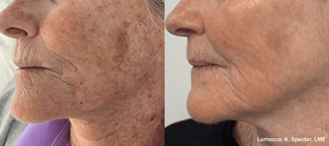Lumecca IPL Before & Afters | PRANA IV Hydration & Wellness Clinic