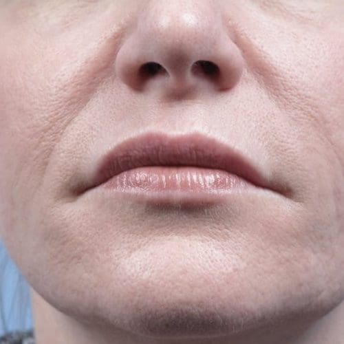 Forma Before and After - Case 3, Image 2 - Female, age 35 – 44 - Fortville, IN - PRANA IV Hydration & Wellness Clinic