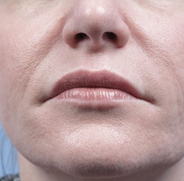 Forma Before & Afters | PRANA IV Hydration & Wellness Clinic