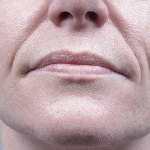 Forma Before and After - Case 3, Image 1 - Female, age 35 – 44 - Fortville, IN - PRANA IV Hydration & Wellness Clinic