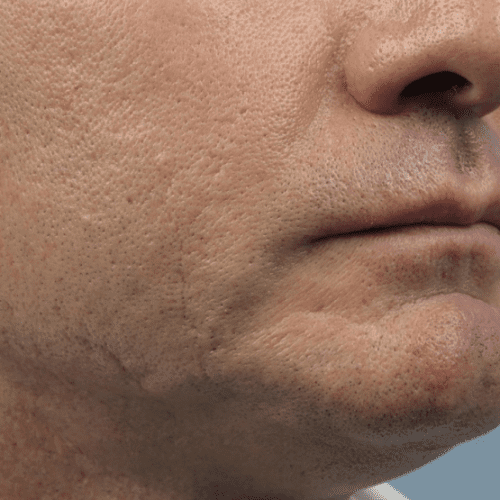 Forma Before and After - Case 2, Image 2 - Male, age 35 – 44 - Fortville, IN - PRANA IV Hydration & Wellness Clinic