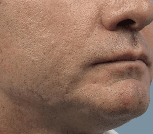 Forma Before and After - Case 2, Image 2 - Male, age 35 – 44 - Fortville, IN - PRANA IV Hydration & Wellness Clinic
