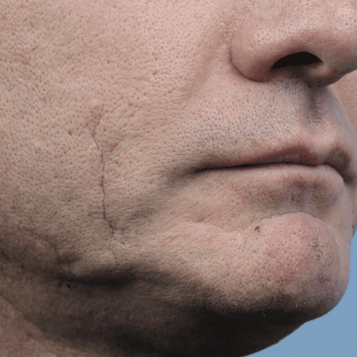 Forma Before and After - Case 2, Image 1 - Male, age 35 – 44 - Fortville, IN - PRANA IV Hydration & Wellness Clinic