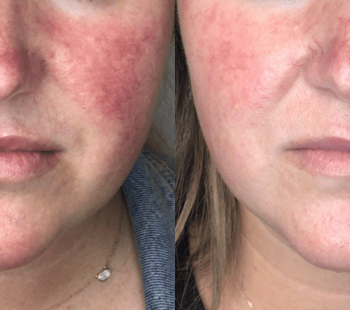 Lumecca IPL Before and After - Case -1, Image 1 - Female, age 25 – 34 - Fortville, IN - PRANA IV Hydration & Wellness Clinic