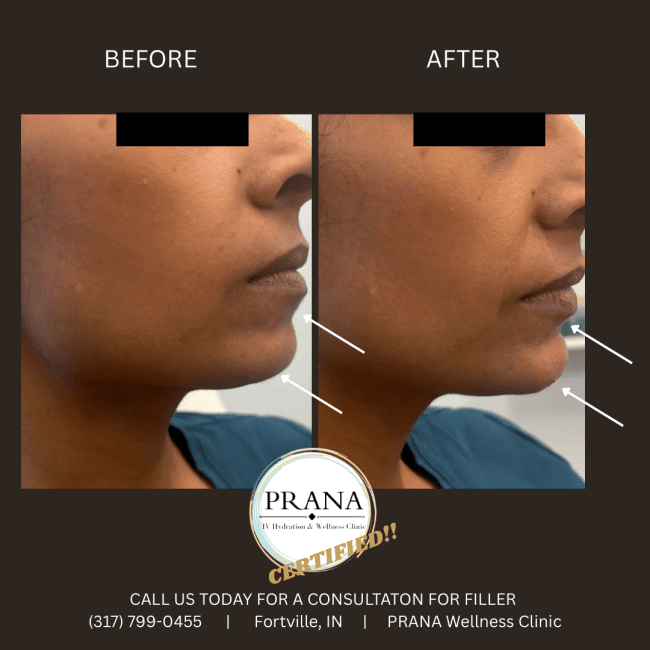 Evolysse Before and After - Case 7, Image 1 - Female, age  - Fortville, IN - PRANA IV Hydration & Wellness Clinic
