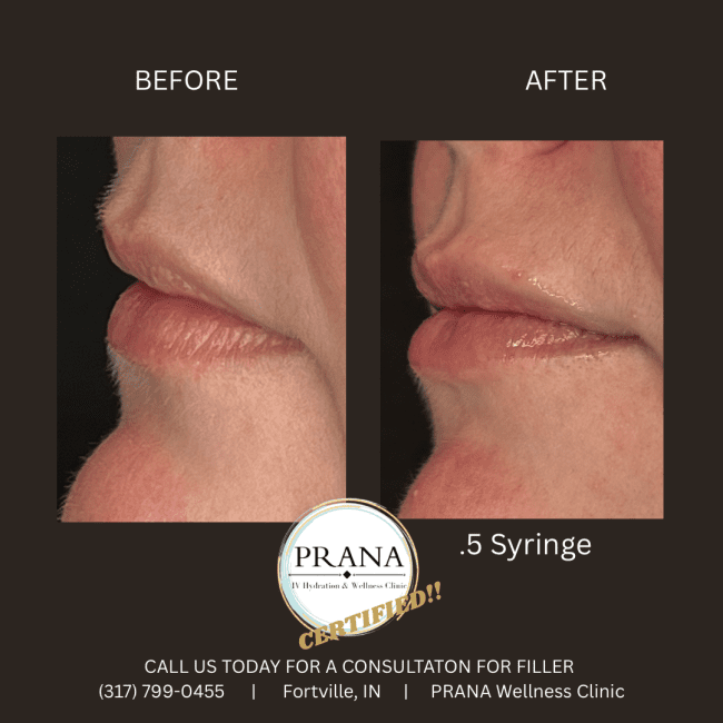 Evolysse Before and After - Case 9, Image 1 - Female, age  - Fortville, IN - PRANA IV Hydration & Wellness Clinic