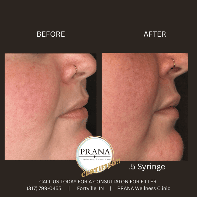 Evolysse Before and After - Case 8, Image 1 - Female, age  - Fortville, IN - PRANA IV Hydration & Wellness Clinic