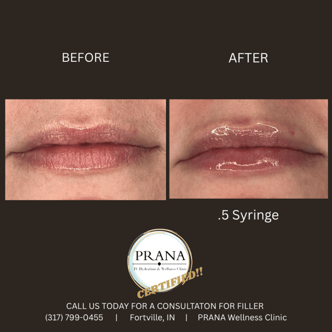 Evolysse Before and After - Case 6, Image 1 - Female, age  - Fortville, IN - PRANA IV Hydration & Wellness Clinic