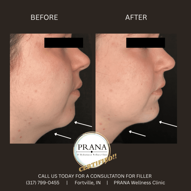 Evolysse Before and After - Case 5, Image 1 - Female, age 18 – 24 - Fortville, IN - PRANA IV Hydration & Wellness Clinic