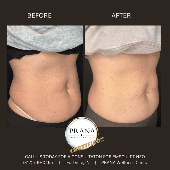 Emsculpt Neo Before and After - Case 26, Image 3 - Female, age  - Fortville, IN - PRANA IV Hydration & Wellness Clinic