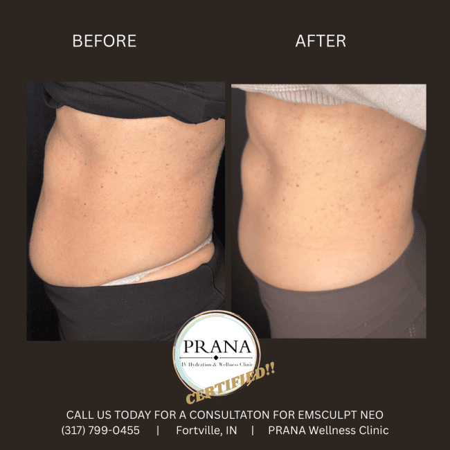Emsculpt Neo Before and After - Case 26, Image 5 - Female, age  - Fortville, IN - PRANA IV Hydration & Wellness Clinic
